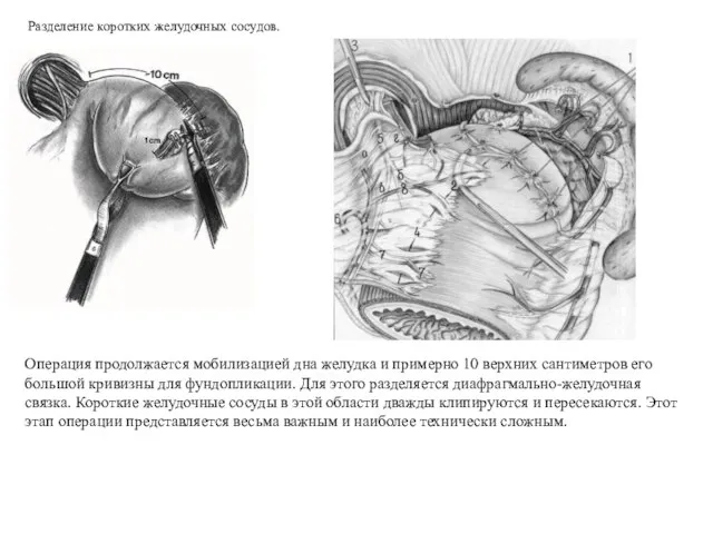 Операция продолжается мобилизацией дна желудка и примерно 10 верхних сантиметров его