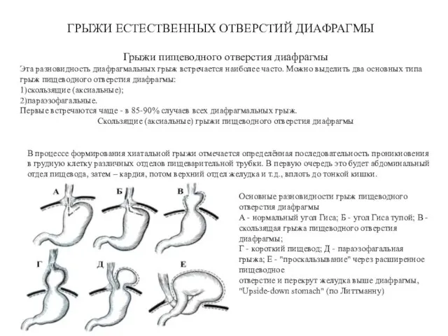 ГРЫЖИ ЕСТЕСТВЕННЫХ ОТВЕРСТИЙ ДИАФРАГМЫ Грыжи пищеводного отверстия диафрагмы Эта разновидность диафрагмальных