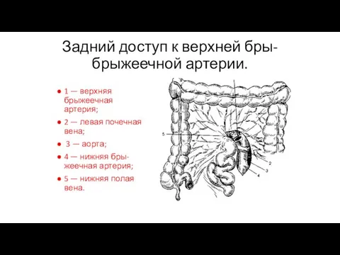 Задний доступ к верхней бры- брыжеечной артерии. 1 — верхняя брыжеечная