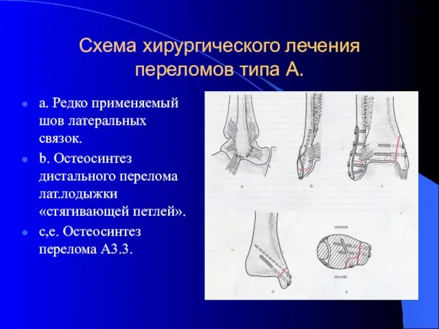 Схема хирургического лечения переломов типа А. a. Редко применяемый шов латеральных