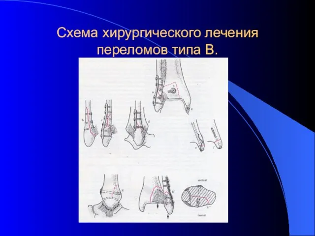 Схема хирургического лечения переломов типа В.