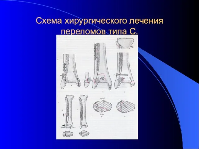 Схема хирургического лечения переломов типа С.