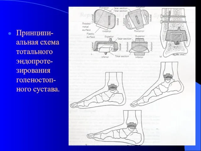 Принципи-альная схема тотального эндопроте-зирования голеностоп-ного сустава.