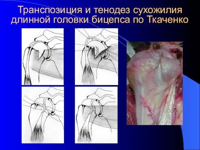 Транспозиция и тенодез сухожилия длинной головки бицепса по Ткаченко