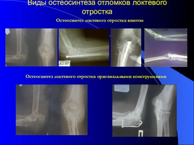 Виды остеосинтеза отломков локтевого отростка Остеосинтез локтевого отростка винтом Остеосинтез локтевого отростка ориганальными конструкциями