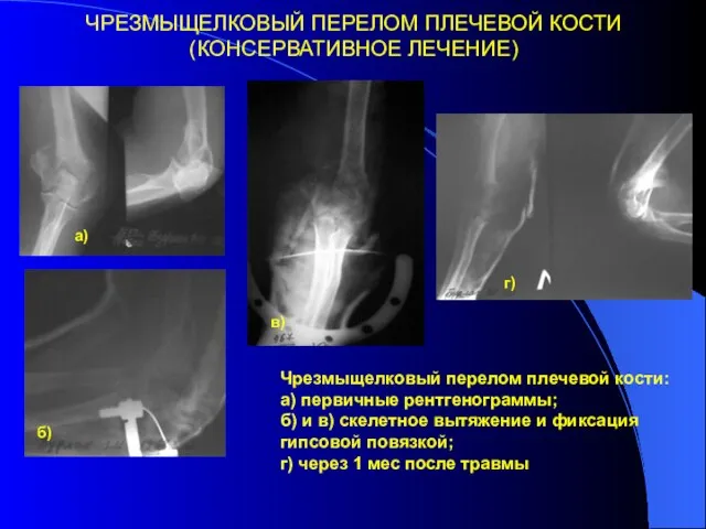 ЧРЕЗМЫЩЕЛКОВЫЙ ПЕРЕЛОМ ПЛЕЧЕВОЙ КОСТИ (КОНСЕРВАТИВНОЕ ЛЕЧЕНИЕ) а) б) в) г) Чрезмыщелковый