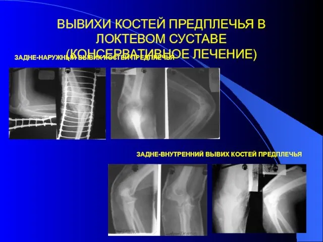 ВЫВИХИ КОСТЕЙ ПРЕДПЛЕЧЬЯ В ЛОКТЕВОМ СУСТАВЕ (КОНСЕРВАТИВНОЕ ЛЕЧЕНИЕ) ЗАДНЕ-НАРУЖНЫЙ ВЫВИХ КОСТЕЙ ПРЕДПЛЕЧЬЯ ЗАДНЕ-ВНУТРЕННИЙ ВЫВИХ КОСТЕЙ ПРЕДПЛЕЧЬЯ