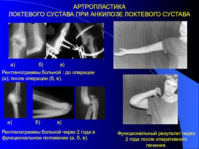 АРТРОПЛАСТИКА ЛОКТЕВОГО СУСТАВА ПРИ АНКИЛОЗЕ ЛОКТЕВОГО СУСТАВА Рентгенограммы больной через 2