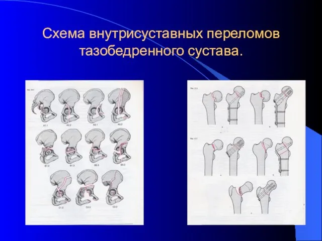 Схема внутрисуставных переломов тазобедренного сустава.