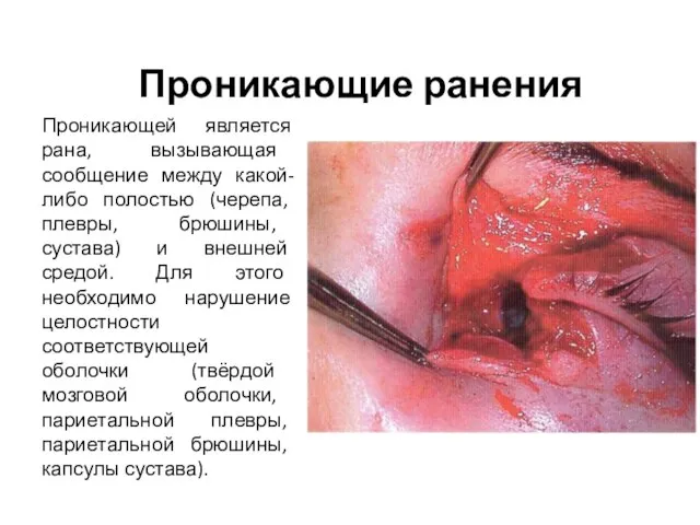 Проникающие ранения Проникающей является рана, вызывающая сообщение между какой-либо полостью (черепа,