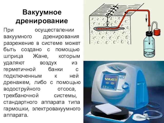 Вакуумное дренирование При осуществлении вакуумного дренирования разрежение в системе может быть