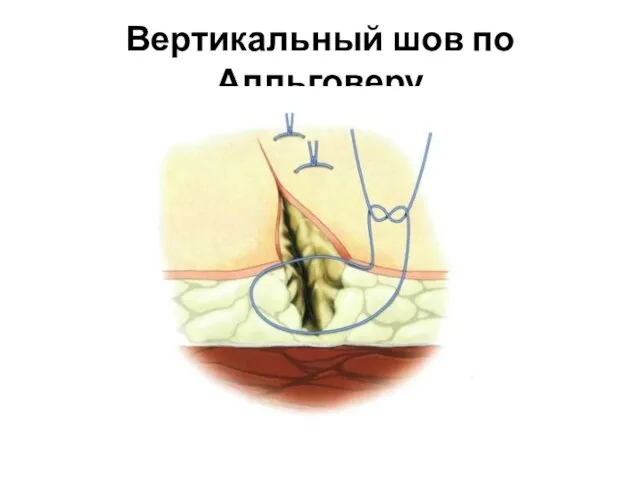 Вертикальный шов по Алльговеру