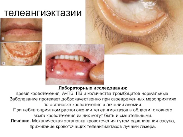 телеангиэктазии Лабораторные исследования: время кровотечения, АЧТВ, ПВ и количества тромбоцитов нормальные.