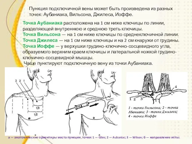 Точка Аубаниака расположена на 1 см ниже ключицы по линии, разделяющей