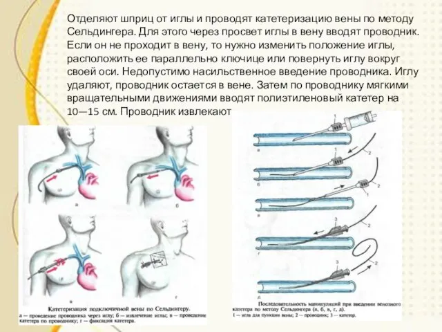 Отделяют шприц от иглы и проводят катетеризацию вены по методу Сельдингера.