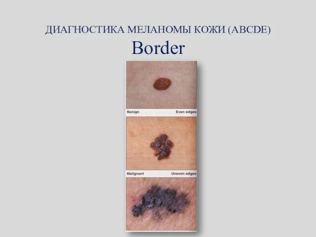 ДИАГНОСТИКА МЕЛАНОМЫ КОЖИ (ABCDE) Border