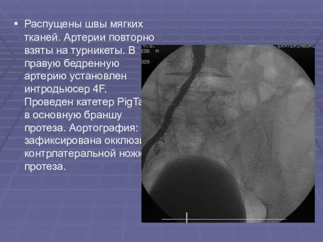 Распущены швы мягких тканей. Артерии повторно взяты на турникеты. В правую