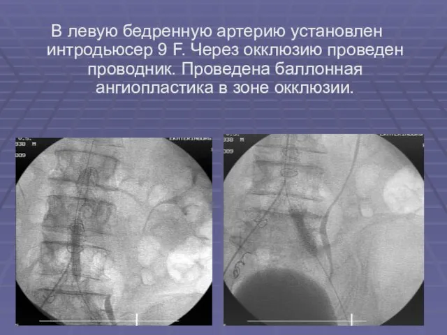 В левую бедренную артерию установлен интродьюсер 9 F. Через окклюзию проведен