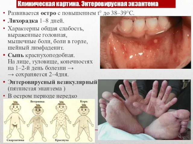 Клиническая картина. Энтеровирусная экзантема Развивается остро с повышением t° до 38–39°С.