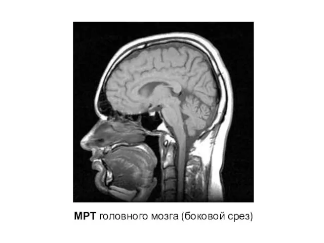 МРТ головного мозга (боковой срез)