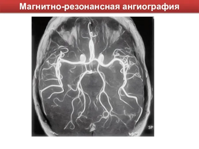 Магнитно-резонансная ангиография