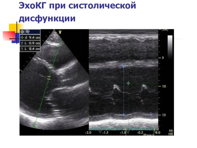 ЭхоКГ при систолической дисфункции