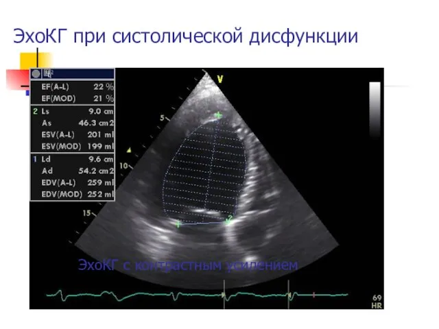 ЭхоКГ при систолической дисфункции ЭхоКГ с контрастным усилением