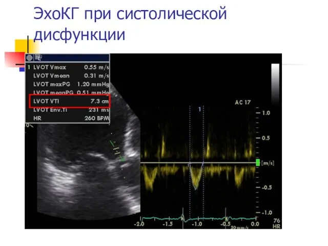 ЭхоКГ при систолической дисфункции