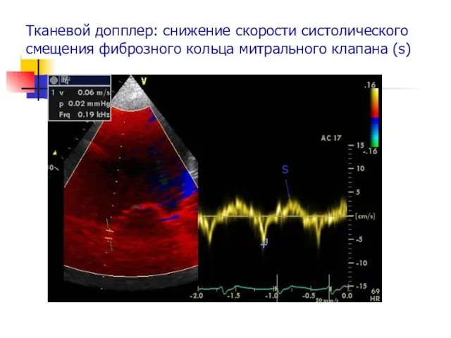 Тканевой допплер: снижение скорости систолического смещения фиброзного кольца митрального клапана (s) s
