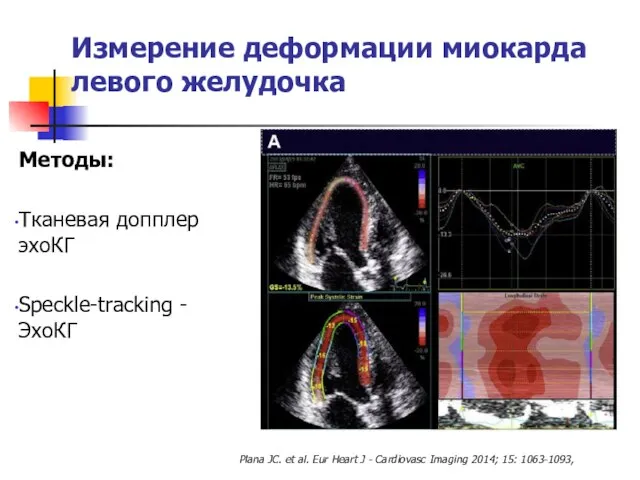 Измерение деформации миокарда левого желудочка Методы: Тканевая допплер эхоКГ Speckle-tracking -