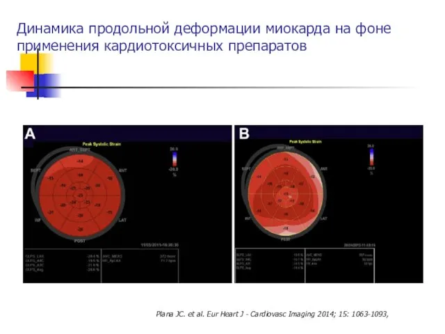 Динамика продольной деформации миокарда на фоне применения кардиотоксичных препаратов Plana JC.