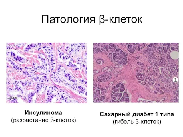 Патология β-клеток Сахарный диабет 1 типа (гибель β-клеток) Инсулинома (разрастание β-клеток)