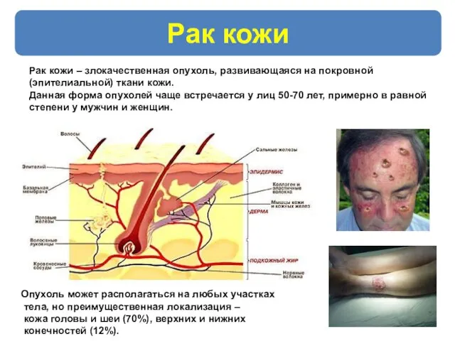 Опухоль может располагаться на любых участках тела, но преимущественная локализация –