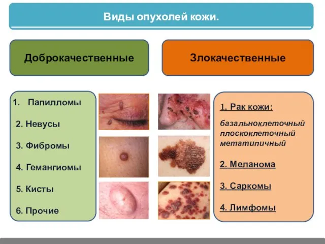 Виды опухолей кожи. Доброкачественные Злокачественные Папилломы 2. Невусы 3. Фибромы 4.