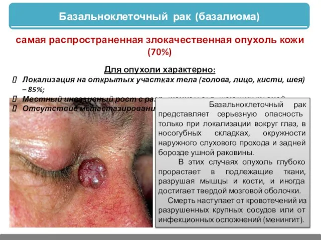 Базальноклеточный рак (базалиома) самая распространенная злокачественная опухоль кожи (70%) Для опухоли