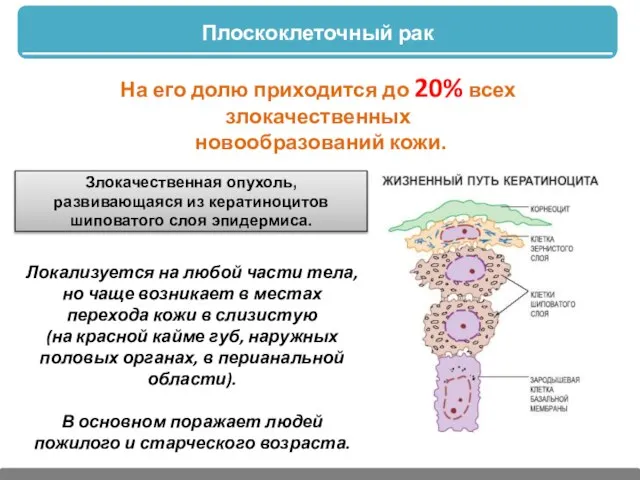 Плоскоклеточный рак Злокачественная опухоль, развивающаяся из кератиноцитов шиповатого слоя эпидермиса. На