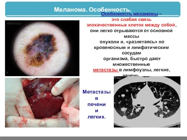 Меланома. Особенность. Особенность меланомы – это слабая связь злокачественных клеток между