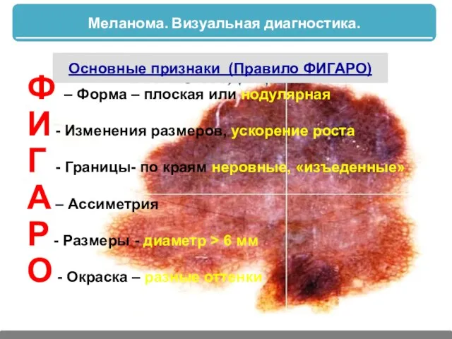 Меланома. Визуальная диагностика. Основные признаки (Правило ФИГАРО) Ф – Форма –