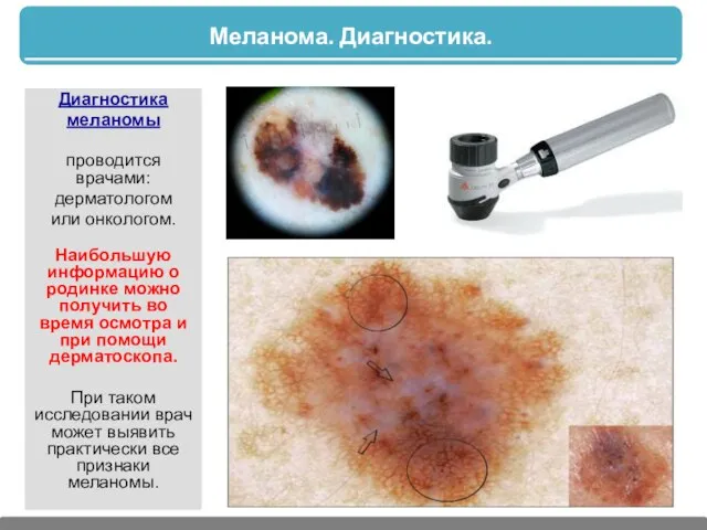 Меланома. Диагностика. Диагностика меланомы проводится врачами: дерматологом или онкологом. Наибольшую информацию