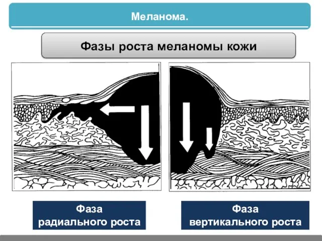 Меланома. Фазы роста меланомы кожи Фаза радиального роста Фаза вертикального роста