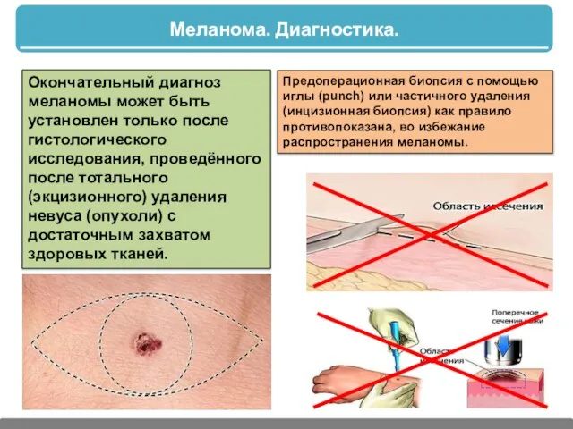 Меланома. Диагностика. Окончательный диагноз меланомы может быть установлен только после гистологического