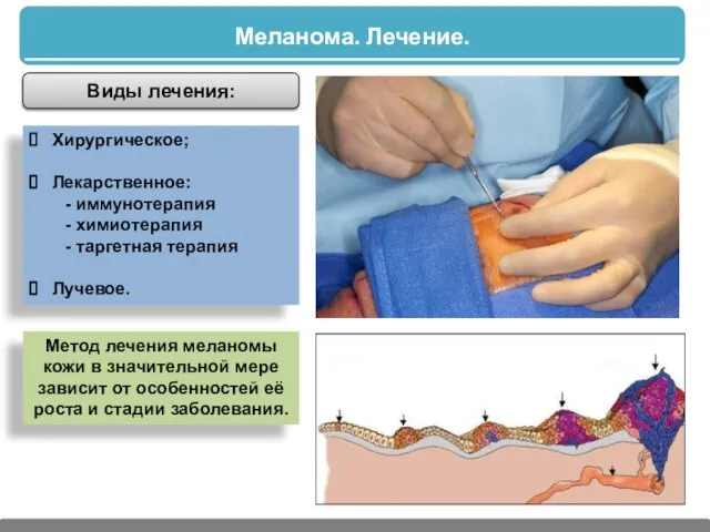 Меланома. Лечение. Виды лечения: Хирургическое; Лекарственное: - иммунотерапия - химиотерапия -