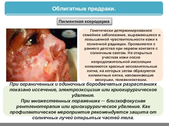 Облигатные предраки. Пигментная ксеродерма Генетически детерминированное семейное заболевание, выражающееся в повышенной