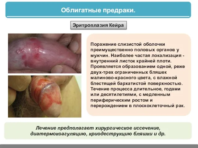 Облигатные предраки. Эритроплазия Кейра Поражение слизистой оболочки преимущественно половых органов у