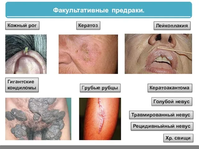 Факультативные предраки. Кожный рог Кератоз Кератоакантома Грубые рубцы Гигантские кондиломы Лейкоплакия