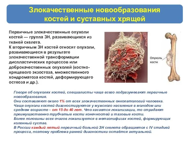 Злокачественные новообразования костей и суставных хрящей Первичные злокачественные опухоли костей —