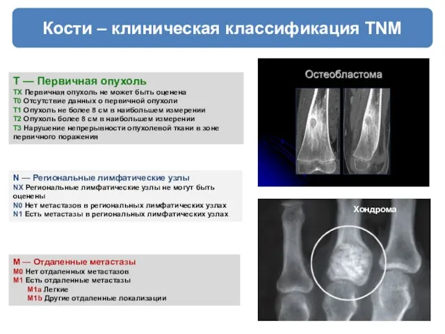 Кости – клиническая классификация TNM T — Первичная опухоль TX Первичная