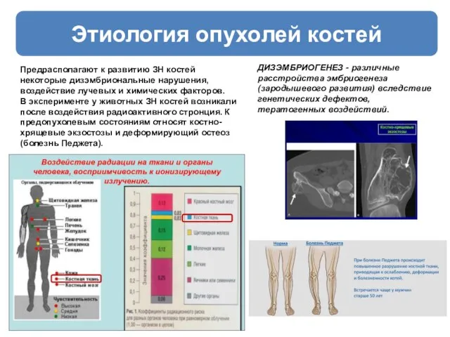 Этиология опухолей костей Предрасполагают к развитию ЗН костей некоторые дизэмбриональные нарушения,