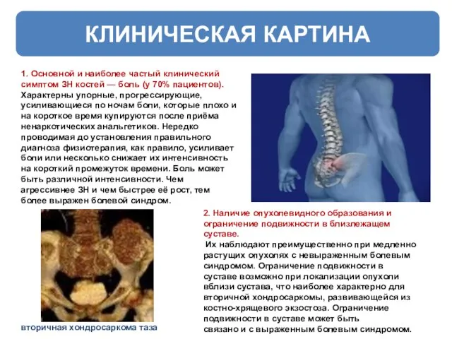 КЛИНИЧЕСКАЯ КАРТИНА 1. Основной и наиболее частый клинический симптом ЗН костей