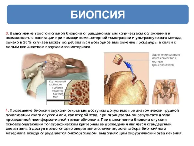 БИОПСИЯ 3. Выполнение толстоигольной биопсии оправдано малым количеством осложнений и возможностью